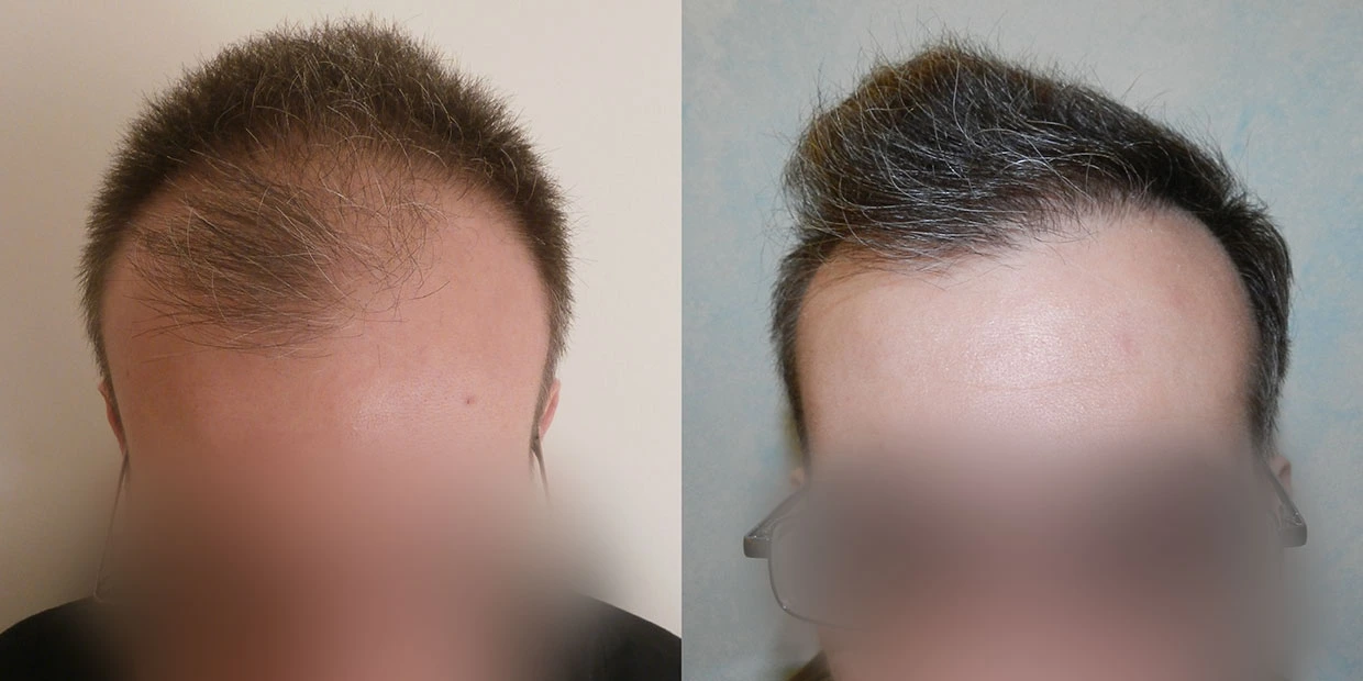 Αποτέλεσμα μεταμόσχευσης μαλλιών