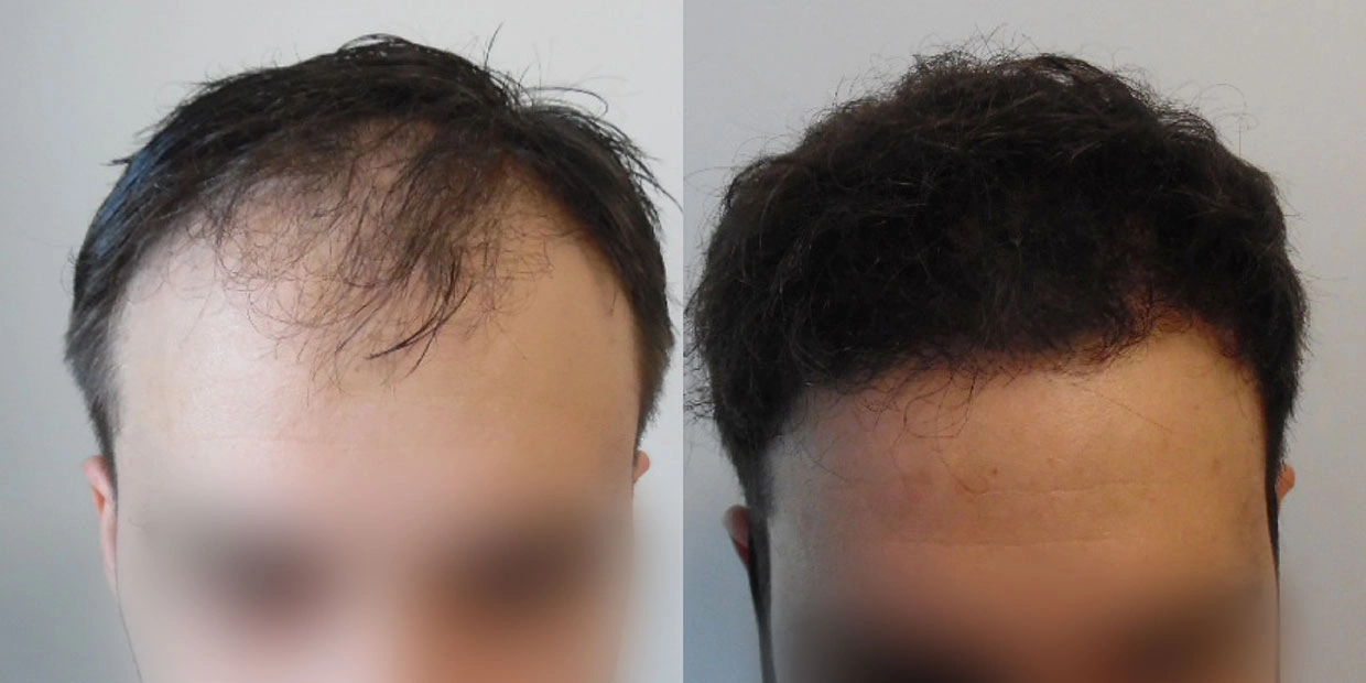 Αποτέλεσμα μεταμόσχευσης μαλλιών