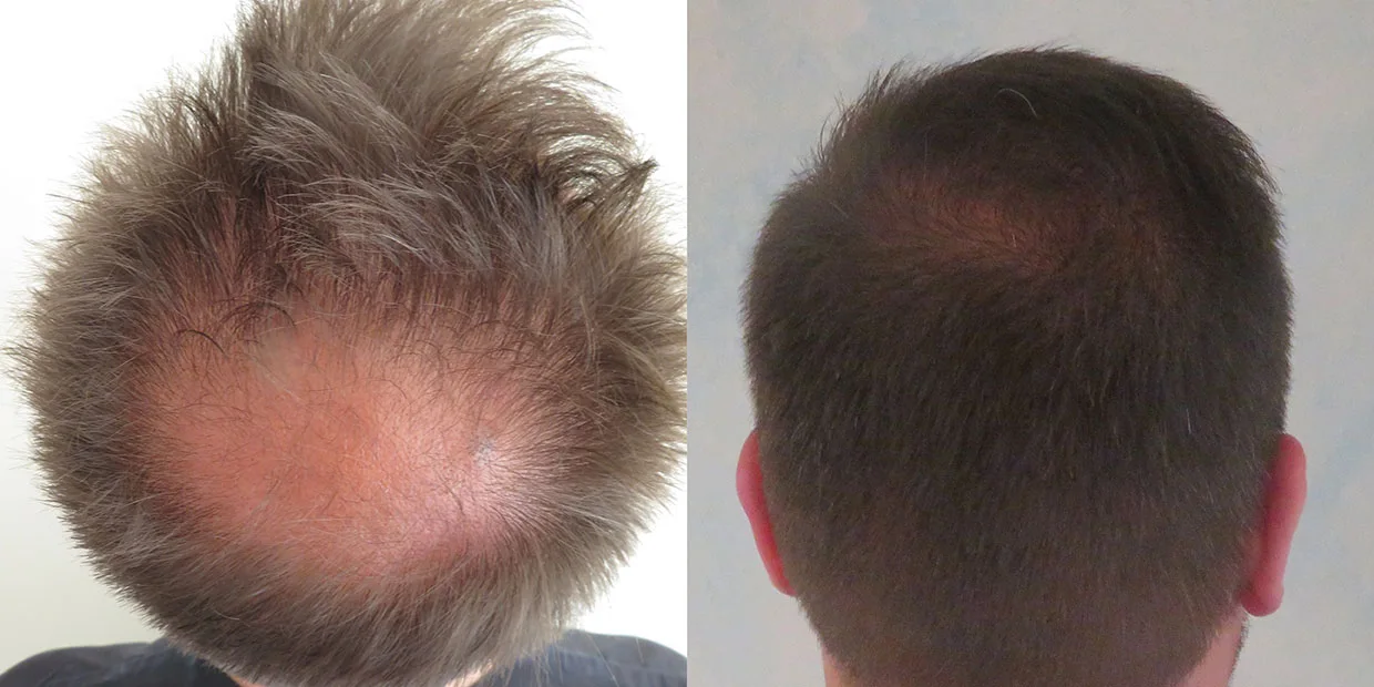 Αποτέλεσμα μεταμόσχευσης μαλλιών