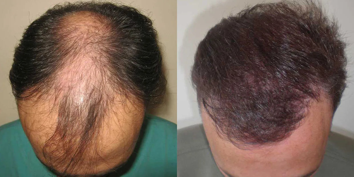 Αποτέλεσμα μεταμόσχευσης μαλλιών