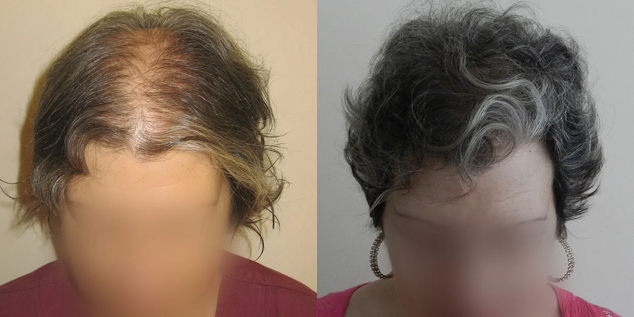 Αποτέλεσμα μεταμόσχευσης μαλλιών