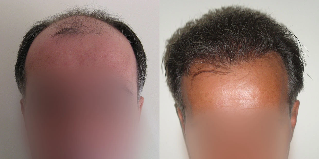 Αποτέλεσμα μεταμόσχευσης μαλλιών