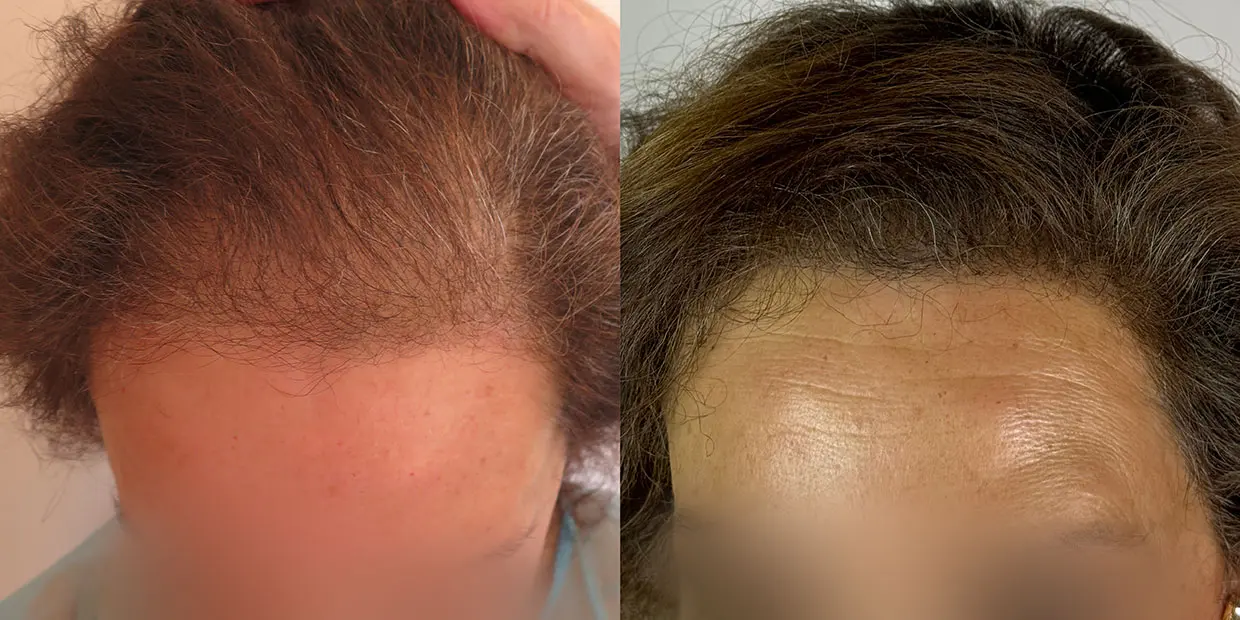 Αποτέλεσμα μεταμόσχευσης μαλλιών