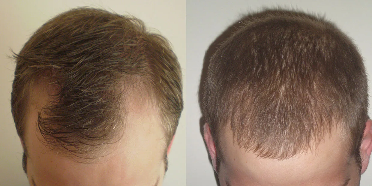 Αποτέλεσμα μεταμόσχευσης μαλλιών