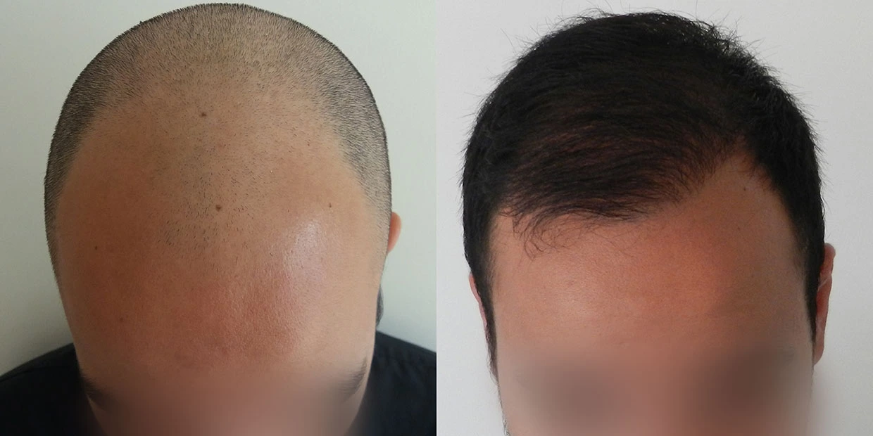 Αποτέλεσμα μεταμόσχευσης μαλλιών