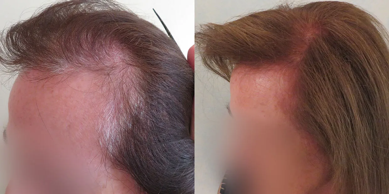 Αποτέλεσμα μεταμόσχευσης μαλλιών