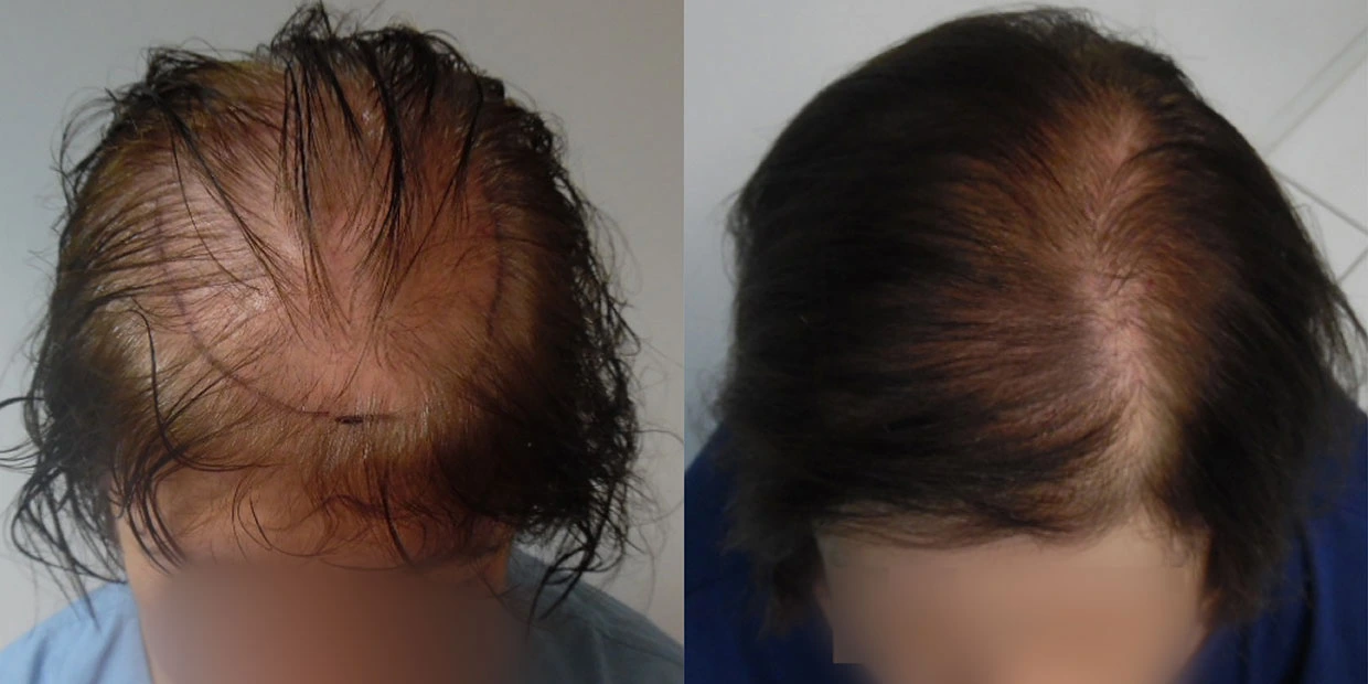 Αποτέλεσμα μεταμόσχευσης μαλλιών