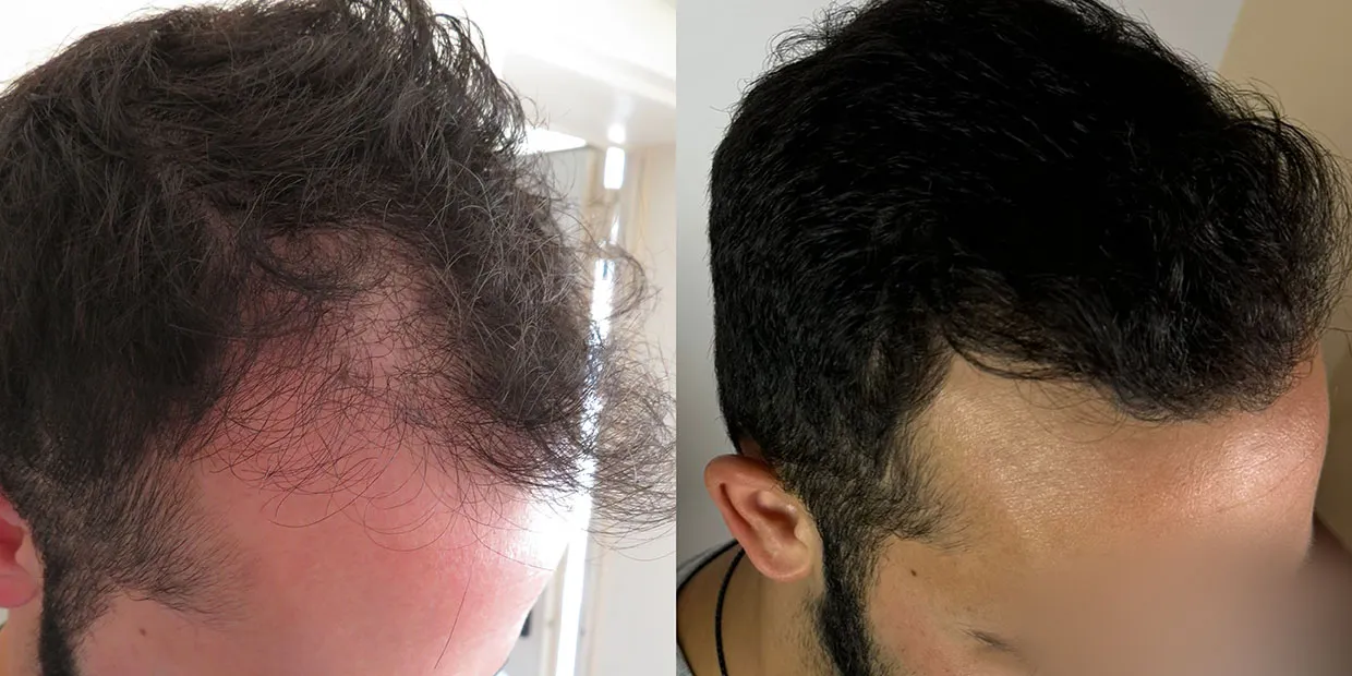 Αποτέλεσμα μεταμόσχευσης μαλλιών