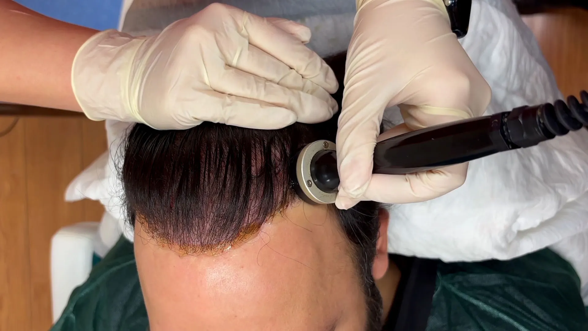 Θεραπεία ιοντοφόρεσης κατά της τριχόπτωσης