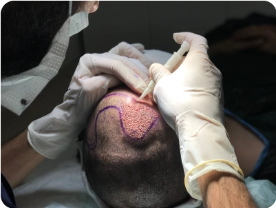 Διόρθωση αποτυχημένης μεταμόσχευσης μαλλιών