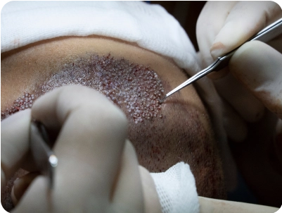 Μεταμόσχευση μαλλιών mega session μεγάλος αριθμός τριχοθυλακίων σε μία συνεδρία.