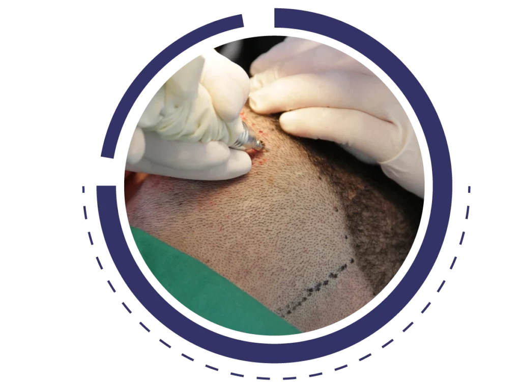 Μεταμόσχευση μαλλιών με την τεχνική FUE