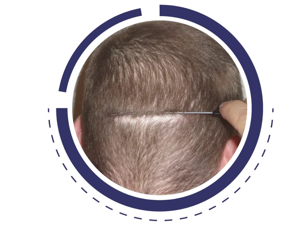 Μεταμόσχευση μαλλιών με την τεχνική FUT