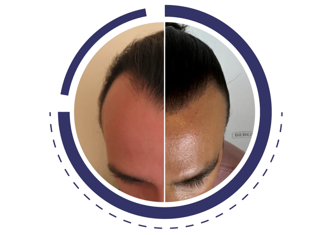 Μεταμόσχευση Μαλλιών αποτέλεσμα σε άνδρα