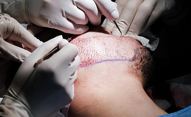 Διαδικασία εμφύτευσης γενιών