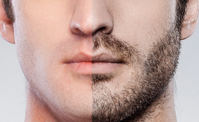 Μεταμόσχευση γενιών σε άνδρα με αραίωση την περιοχή.