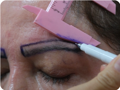 Εμφύτευση φρυδιών σε γυναίκα