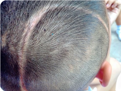 Μεταμόσχευση μαλλιών για την κάλυψη ουλής στο τριχωτό της κεφαλής