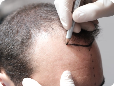 Σχεδιασμός για την μεταμόσχευση μαλλιών σε άνδρα