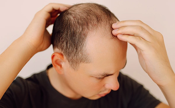 Νεαρός που έχει διαγνωστεί με Ανδρογενετική Αλωπεκία