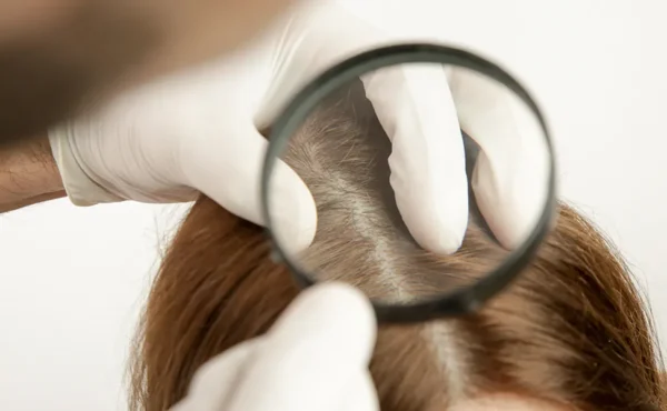 Διάγνωση σχετικά με την τριχόπτωση σε γυναίκα με σκοπό την σωστή αντιμετώπιση της