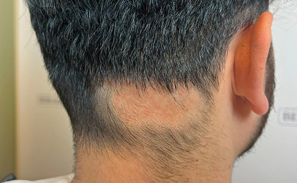 Ουλωτική Αλωπεκία στο πίσω μέρος του τριχωτού της κεφαλής