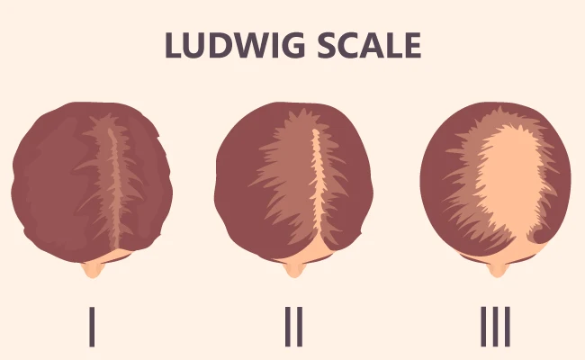 Ludwig Scale