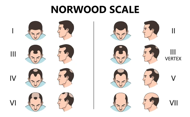 Norwood Scale