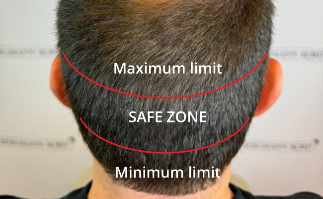 Donor area Hair Transplant