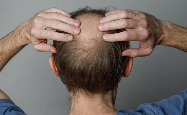 Άντρας με αραίωση στην κόρυφη