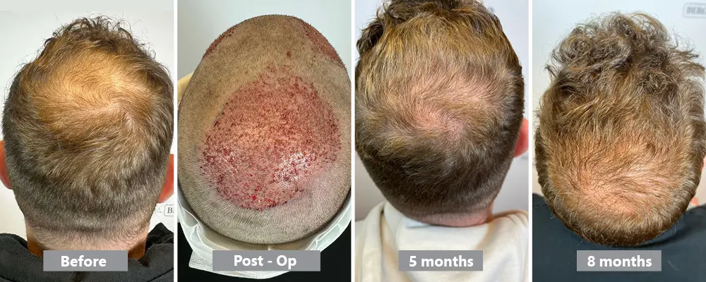 Hair transplant on the crown