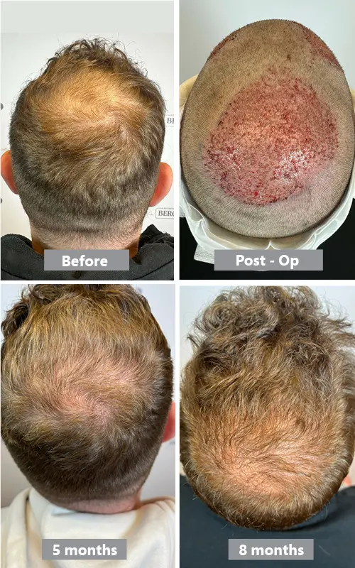 Hair transplant on the crown