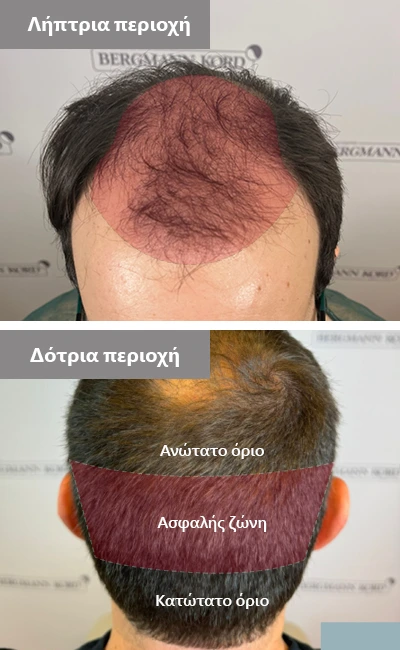 Δότρια και λήπτρια περιοχή στη μεταμόσχευση μαλλιών