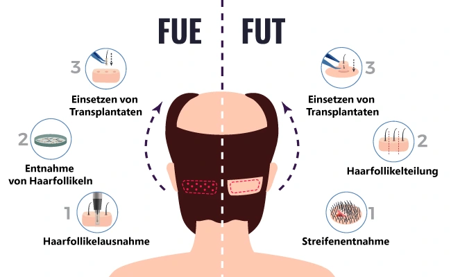 FUE FUT Haartransplantation