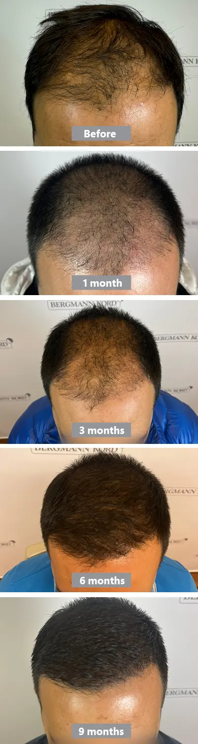 Hair Transplantation 9 Months Result