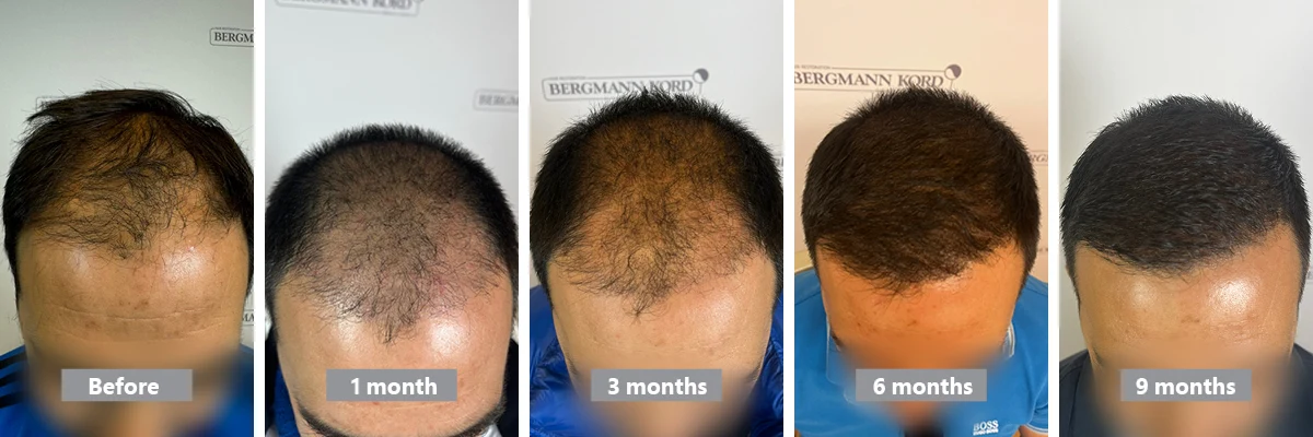 Hair transplantation result month by month