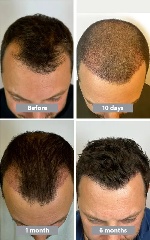 Hair transplantation timeline