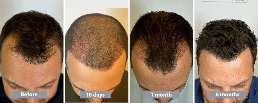 Hair transplantation timeline