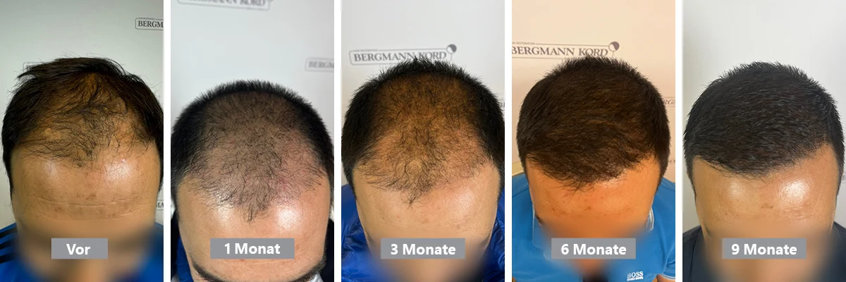 Zeitlicher Verlauf des Ergebnisses einer Haartransplantation nach 9 Monaten