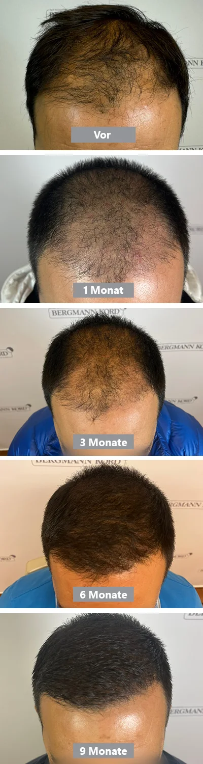 Zeitlicher Verlauf des Ergebnisses einer Haartransplantation nach 9 Monaten