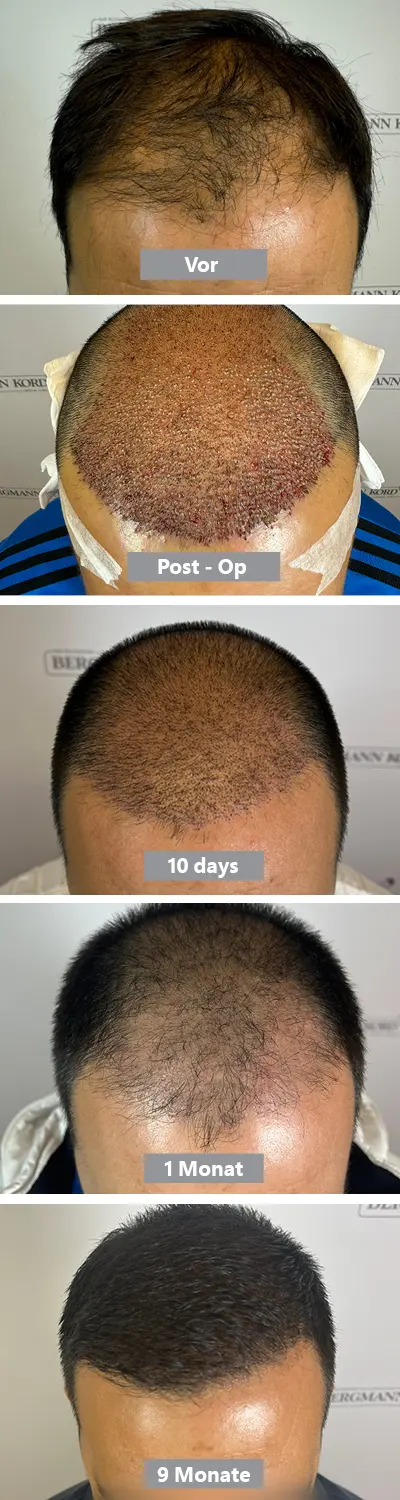Hair Transplant Recipient Area Timeline