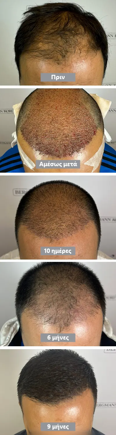 Χρονοδιάγραμμα Μεταμόσχευσης Μαλλών στη Λήπτρια Περιοχή