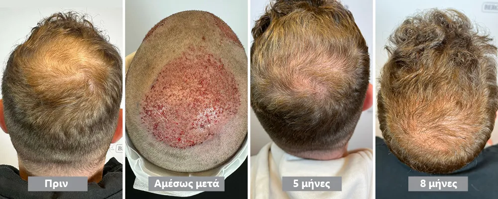 Μεταμόσχευση μαλλιών στην κορυφή