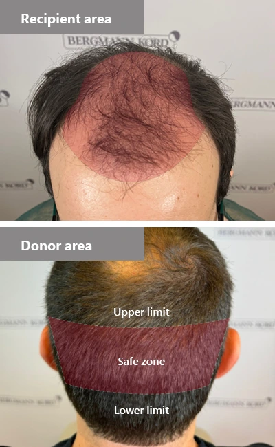 Recipient and area of hair transplantation