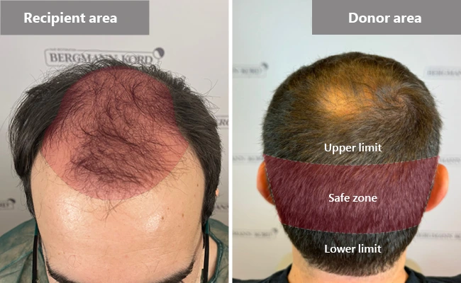 Recipient and area of hair transplantation