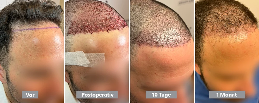 Ergebnis des Schockverlusts 1 Monat danach