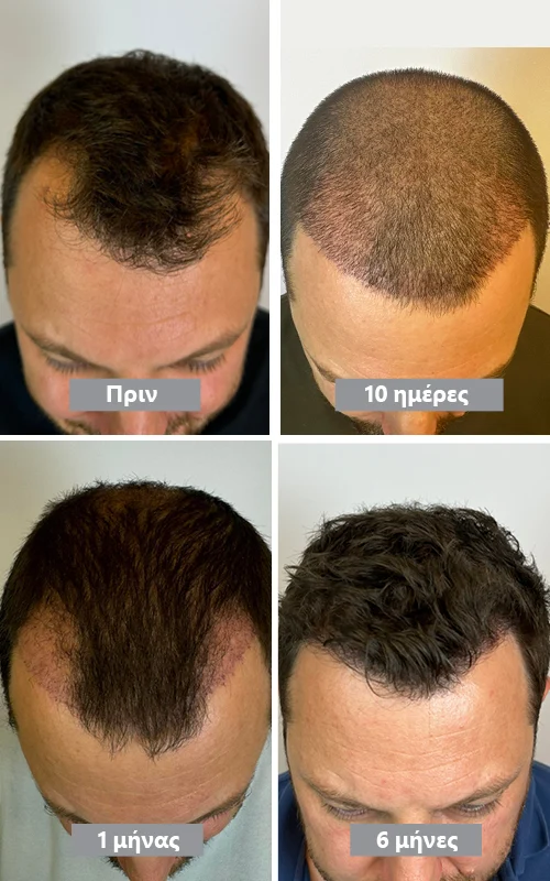 Αποτέλεσμα μεταμόσχευσης μαλλιών