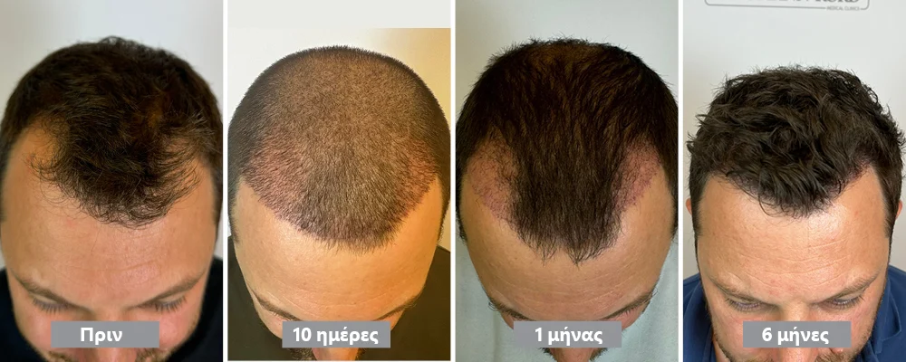 Αποτέλεσμα μεταμόσχευσης μαλλιών