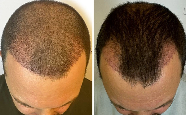 Shock Loss μετά τη μεταμόσχευση μαλλιών