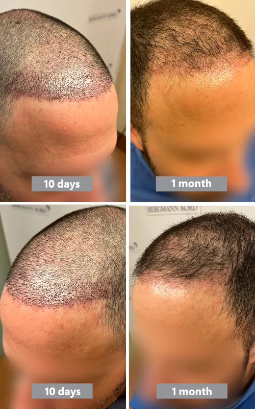 Shock Loss Result 1 Month after